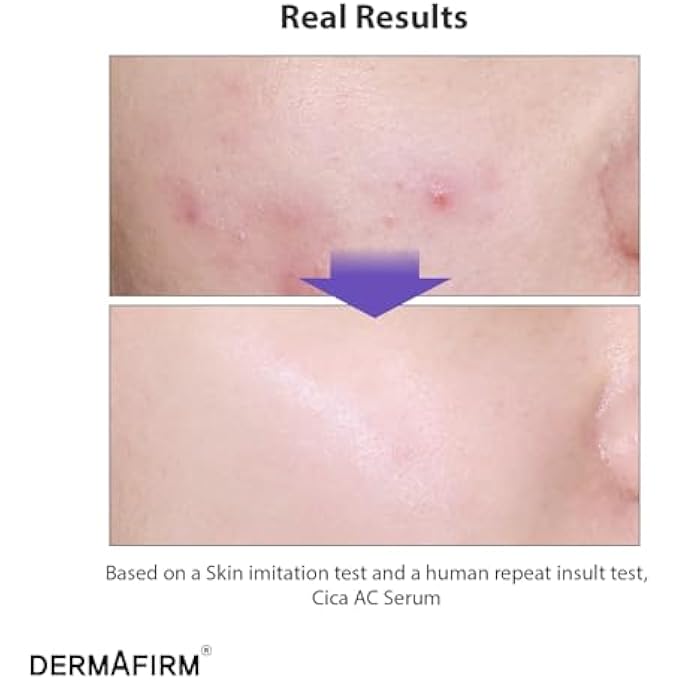 Dermafirm CICA AC SERUM 1.01 FL OZ | SKIN BRIGHTENING SERUM | NIACINAMIDE SERUM FOR FACE | SALICYLIC ACID SERUM | VITAMIN B3 SERUM FOR FACE | FERULIC ACID SERUM BEAUTY & PERSONAL CARE FOR WOMEN & MEN - Image 2